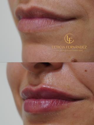 comparativa de unos labios antes y después del tratamiento con ácido hialurónico