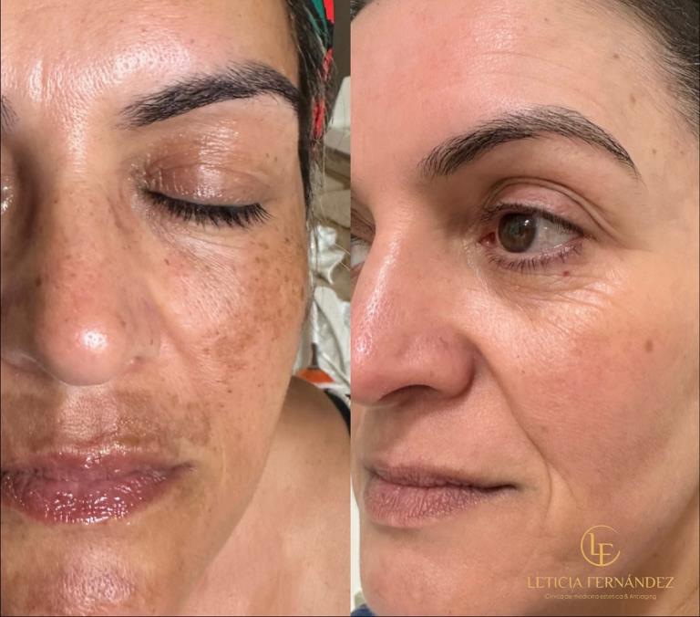 Regeneración cutánea avanzada