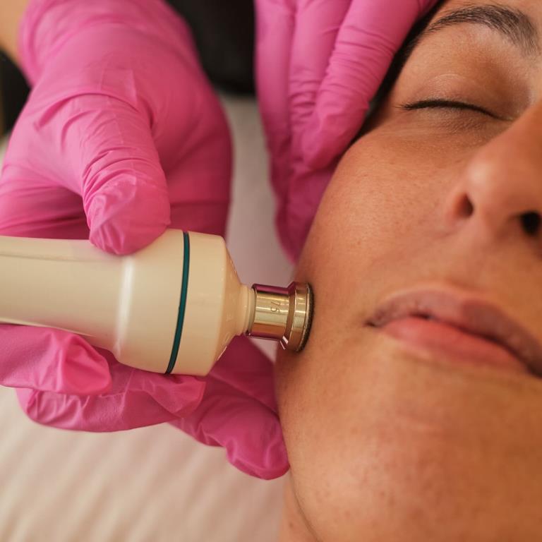 Microdermoabrasión facial para una piel renovada