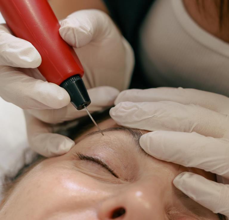 Plasmage: Lifting de párpados sin cirugía