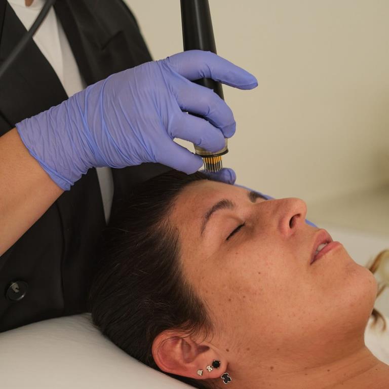 Corona fraccionada pulsada para un rejuvenecimiento profundo