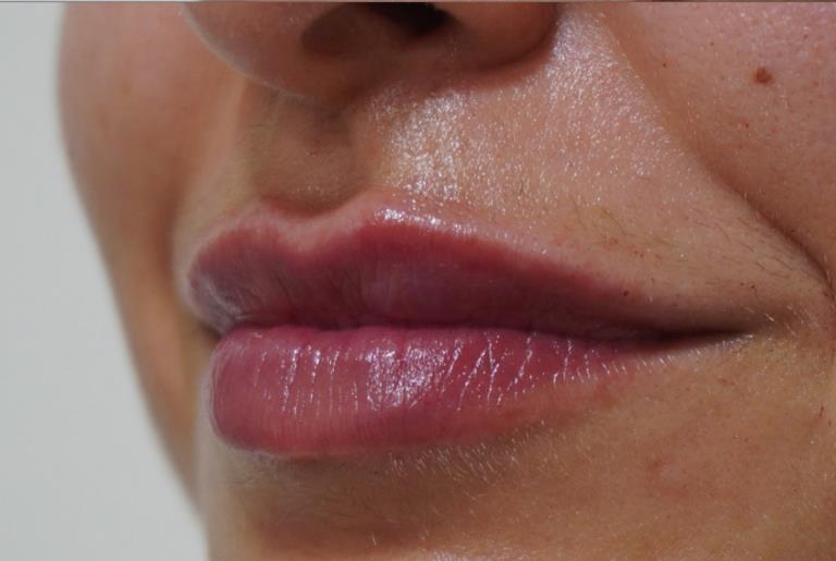 Remodelación y rejuvenecimiento facial